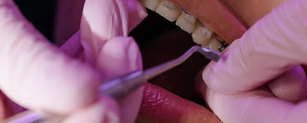 orthodontist working on a patients teeth